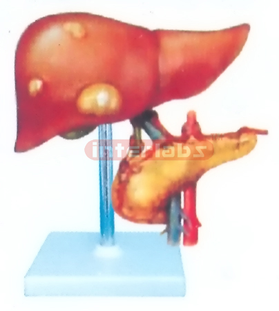 CANCER DISEASE LIVER AND PANCREAS MODEL WITH DESCRIPTION PLATE